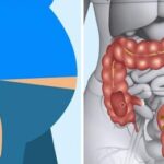 Dicas caseiras para tratar o intestino preso