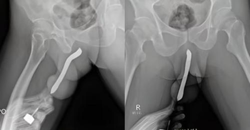 Homem coloca escova de dentes no órgão genital para turbinar relação e é internado