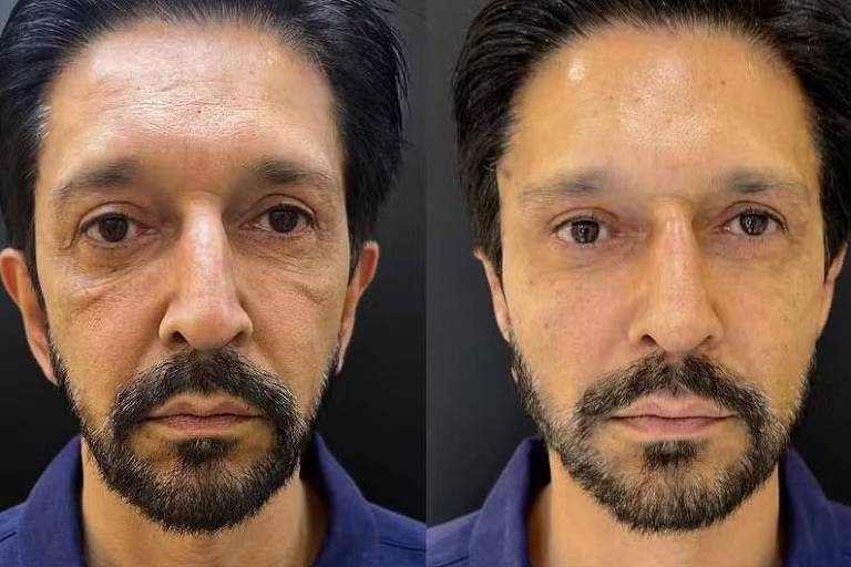 Ricardo Nunes faz harmonização facial; veja o antes e depois